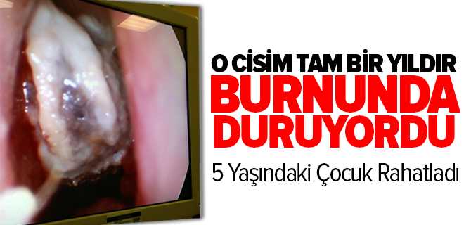 5 Yaşındaki Çocuğun Burnundan Zeytin Çiğidi Çıkartıldı