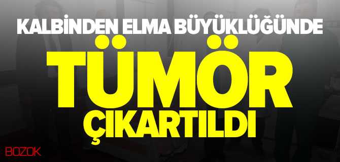 Hastanın Kalbinden Elma Büyüklüğünde Tümör Çıkartıldı